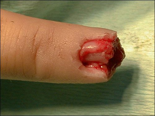 Finger fresh from the wound