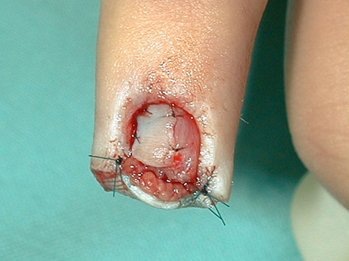 Finger fresh from the wound